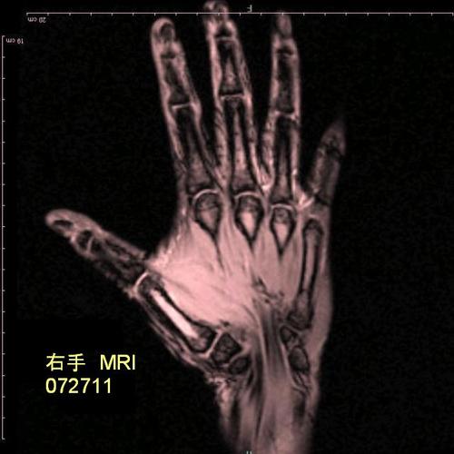 右手MRI072711.JPG